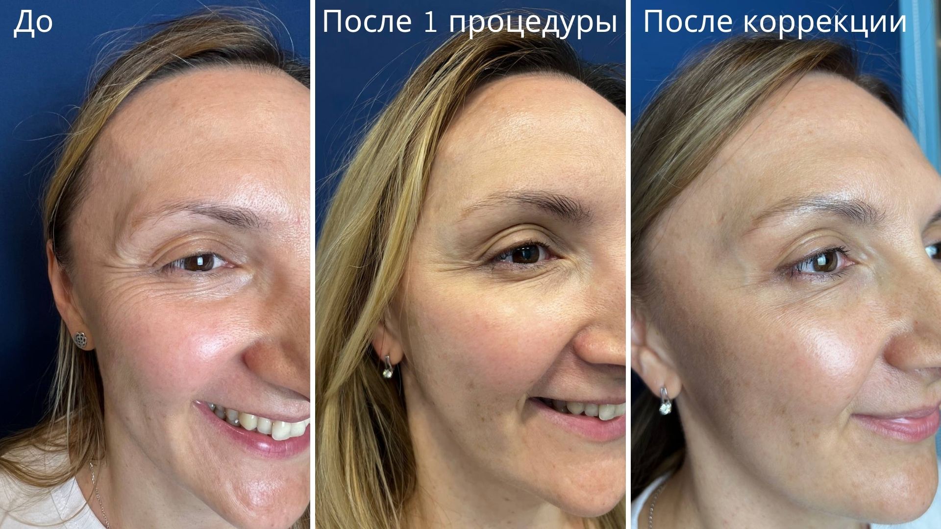 Мимика в зоне глаз во время улыбки на разных этапах процедуры ботулинотерапии
